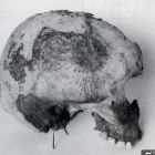 Demi-crâne de l'un des trois cadavres présents sur l'épave (d'après Joncheray 2007, p. 144 © J.-P. Joncheray)